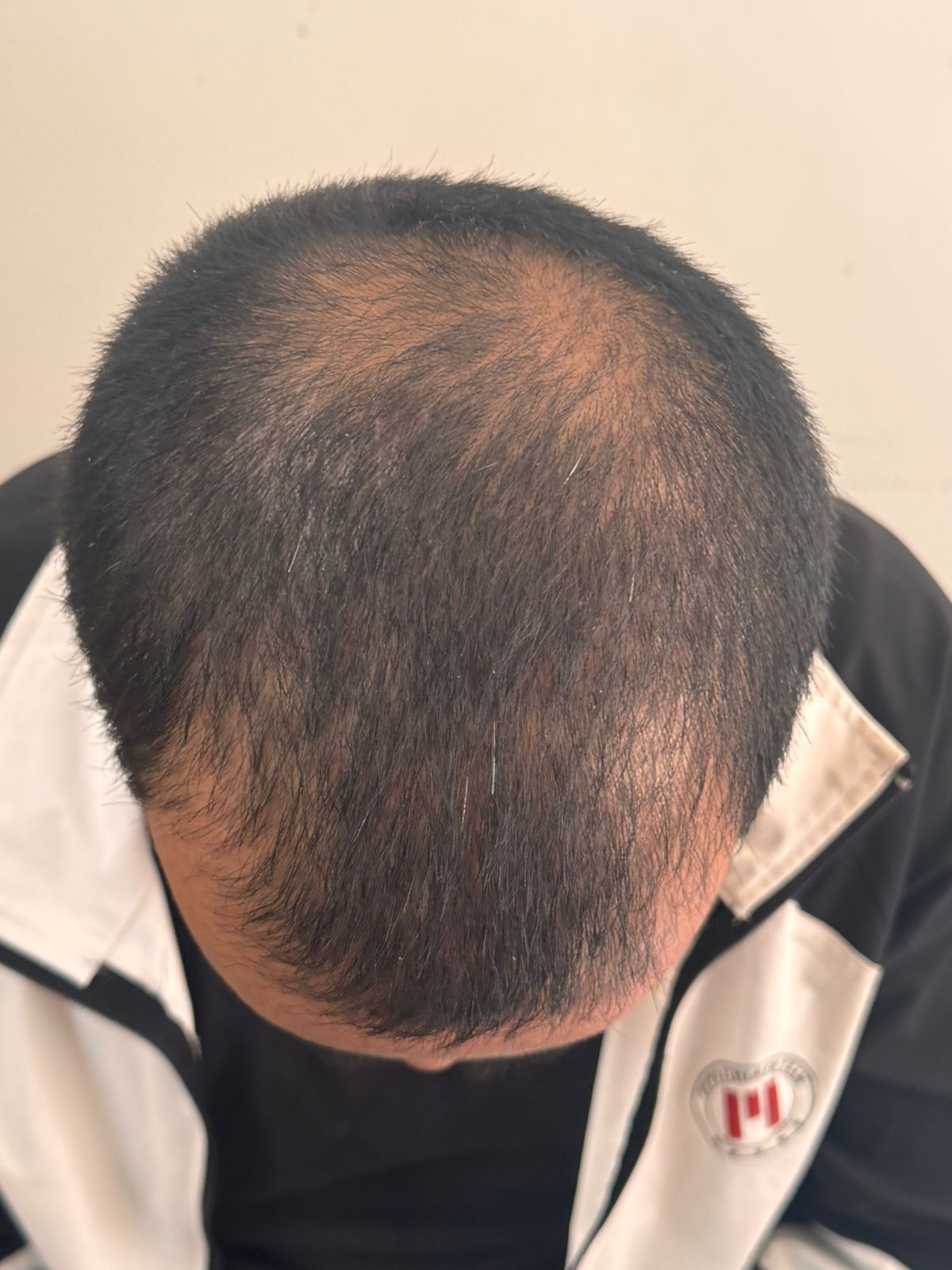 Hair Fall Treatments